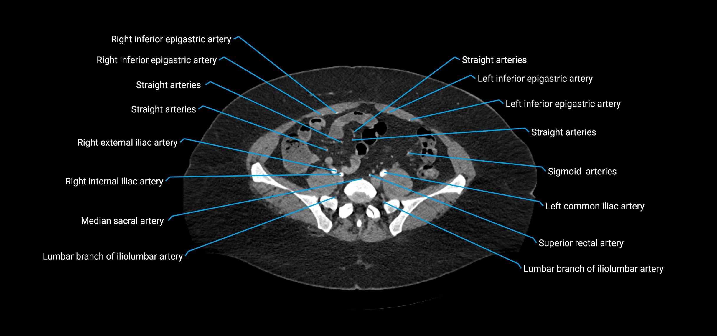 CTA abdomen axial cross sectional anatomy labelled image_173 (2).webp